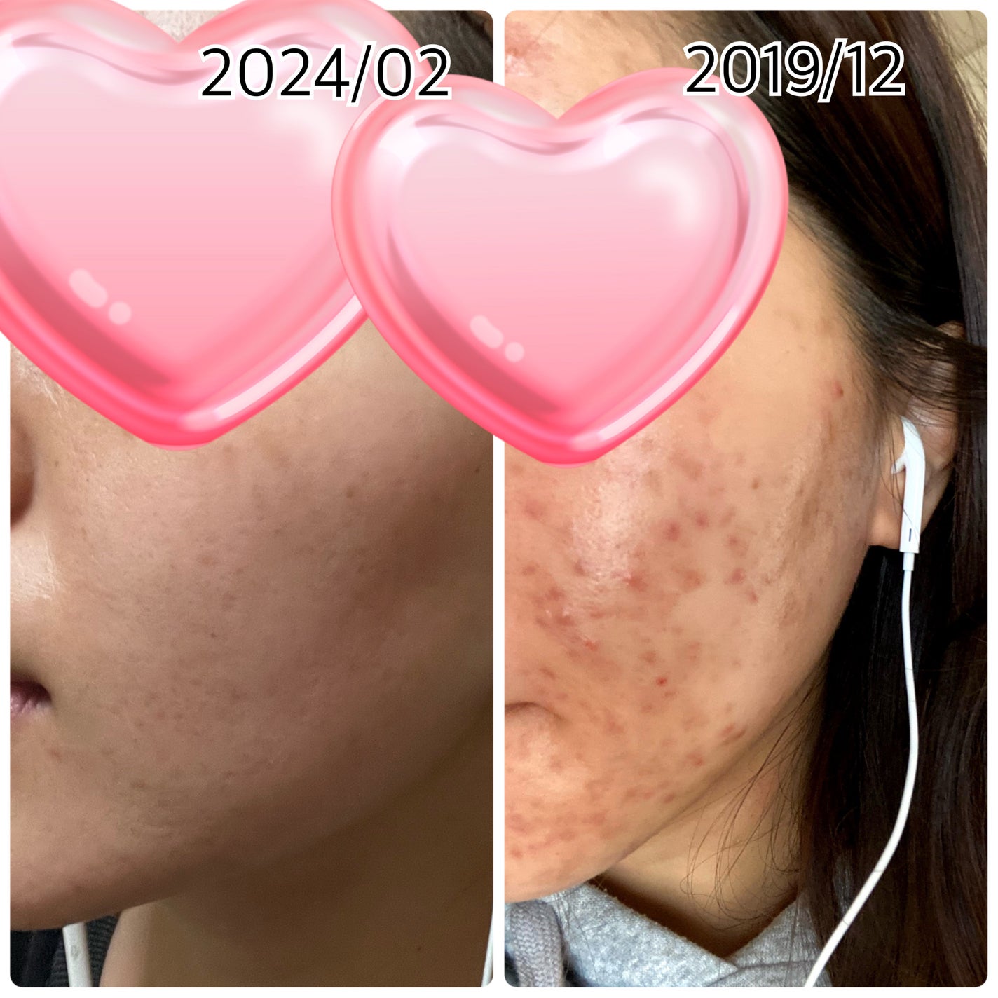 エッセンスイン クレンジングフォーム/d プログラム/洗顔フォームを使ったクチコミ(1枚目)