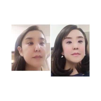 ミノン アミノモイスト 薬用アクネケア ローション/ミノン/化粧水を使ったクチコミ(6枚目)