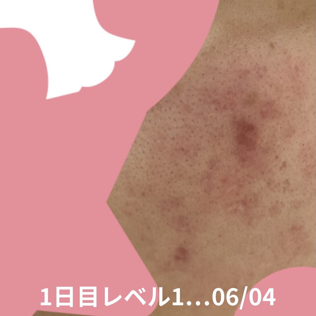 AGE-Rダーマエアショット/MEDICUBE/美顔器・マッサージを使ったクチコミ（2枚目）