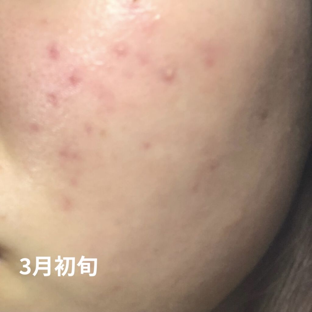 ビタミンC「2000」（医薬品）/武田薬品工業/健康サプリメントを使ったクチコミ（2枚目）