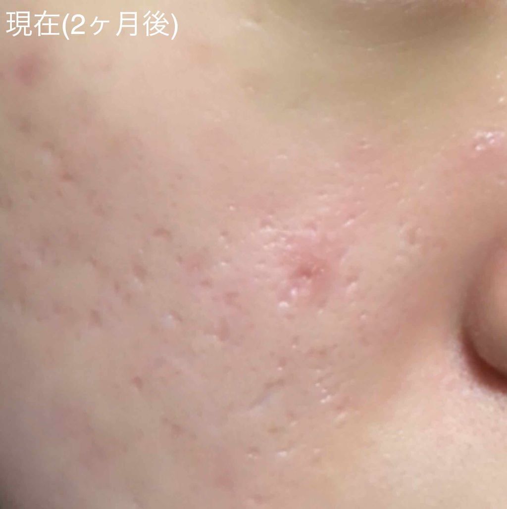 バイオイル/バイオイル/フェイスオイルを使ったクチコミ(4枚目)