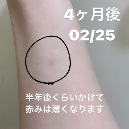 ハイドロコロイドパッド厚型 普通/matsukiyo/その他を使ったクチコミ(3枚目)