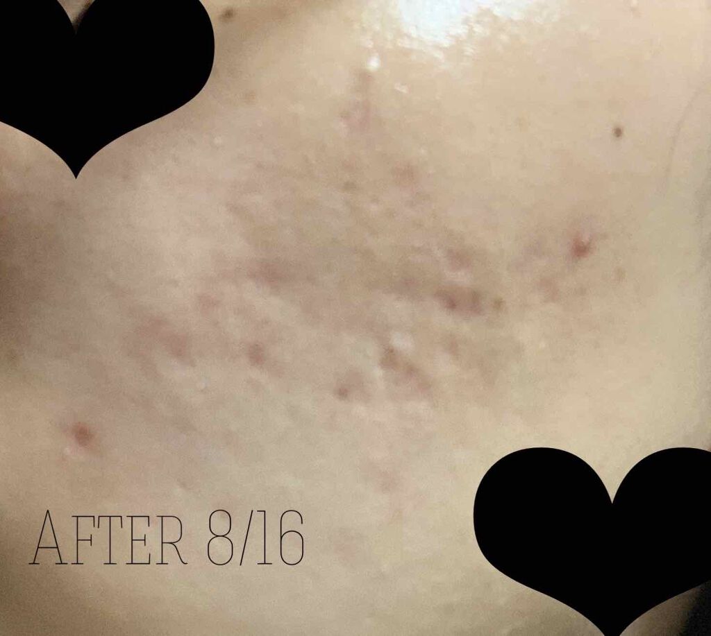 PLACENTREX EXTRACT GEL(ヒトプラセンタジェル)/Placentrex/その他を使ったクチコミ(3枚目)