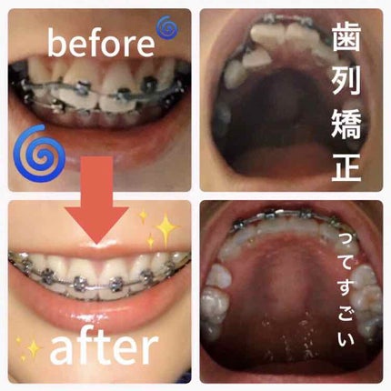 マウスピース矯正/その他を使ったクチコミ(1枚目)
