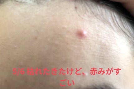 薬用 しみ 集中対策 美容液/メラノCC/美容液を使ったクチコミ(5枚目)