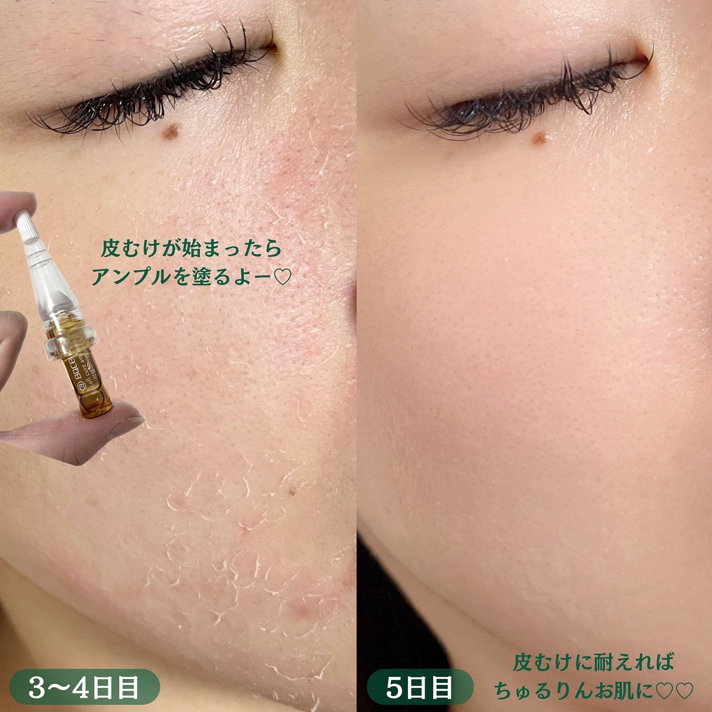 ダーマスキンピーリング/BQCELL/その他キットセットを使ったクチコミ(5枚目)