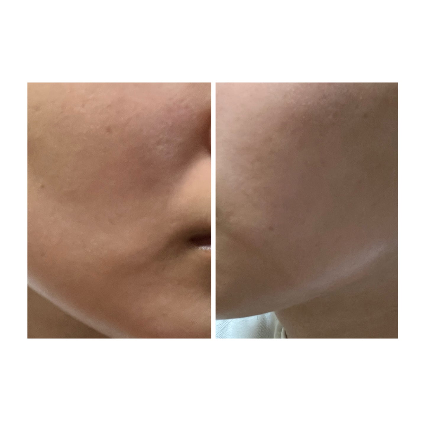 ぽむ on LIPS 「2023.9.13皮膚科に受診 エピデュオとヘパリン処方1枚目..」(5枚目)