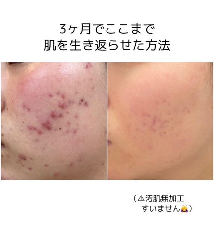 デリケートセット/エンビロン/スキンケアキットを使ったクチコミ(1枚目)