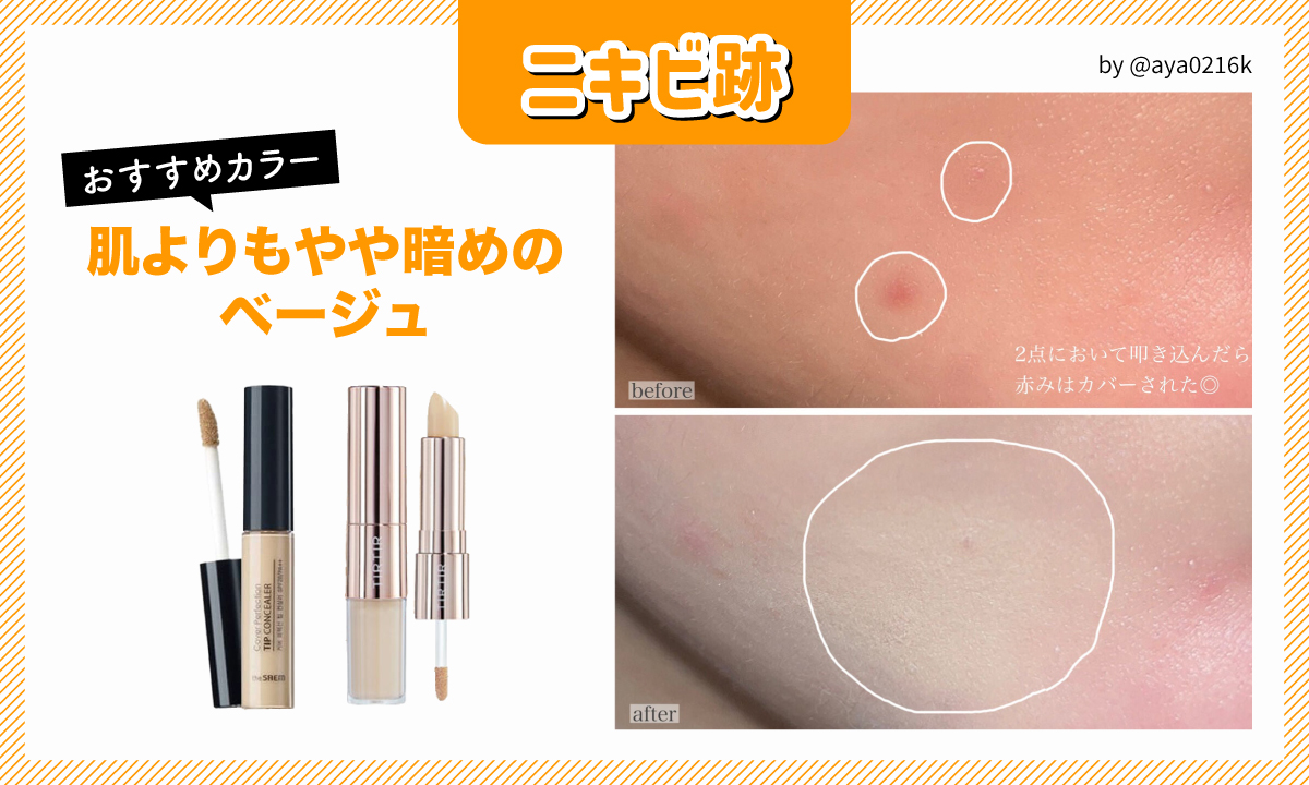 ニキビ跡におすすめのカラーは、肌よりもやや暗めのベージュ。