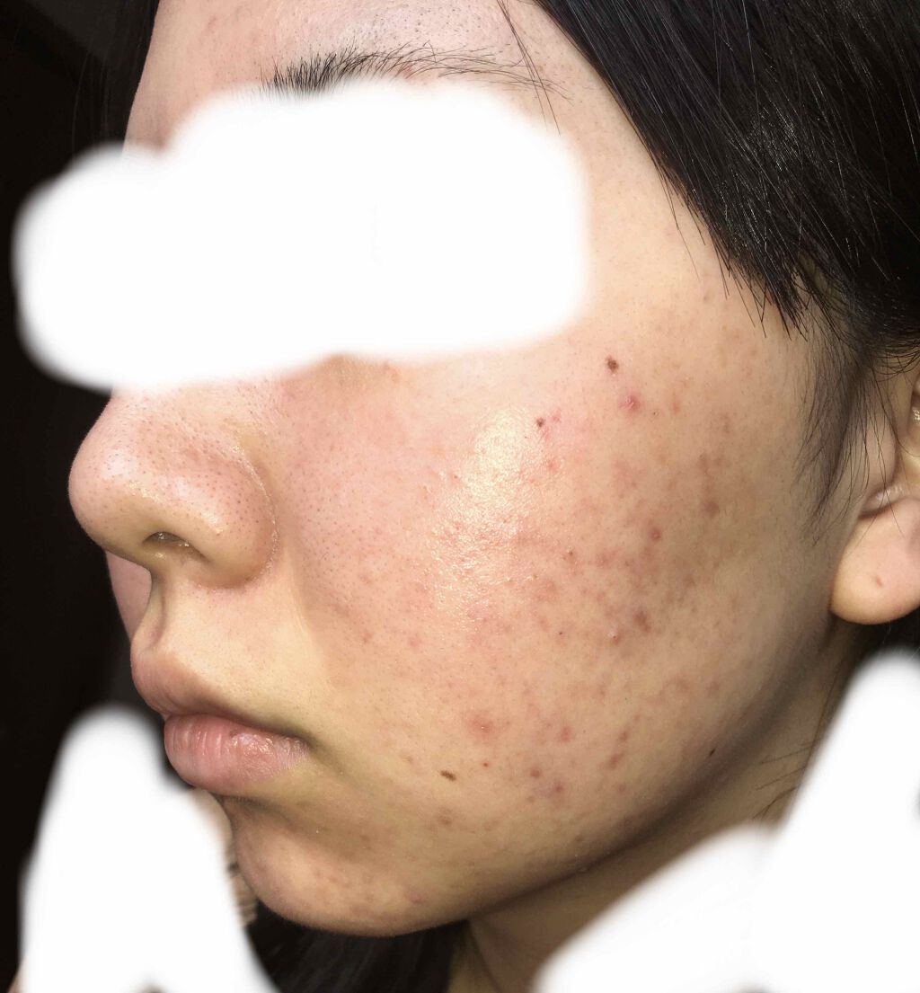 デュアック配合ゲル/ポーラファルマ/その他を使ったクチコミ（2枚目）