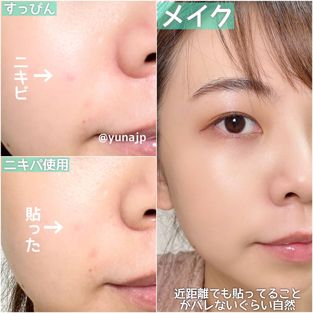 極薄透明パッチ nikipa!/金冠堂/にきびパッチを使ったクチコミ(4枚目)
