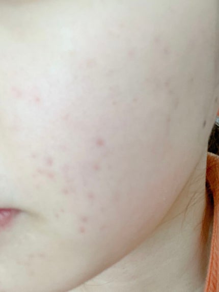 ニキビあとケアジェル/アットノン/その他スキンケアを使ったクチコミ(1枚目)