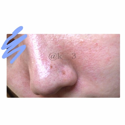 エッセンスマスク (ビタミンC)/クリアターン/シートマスク・パックを使ったクチコミ(3枚目)