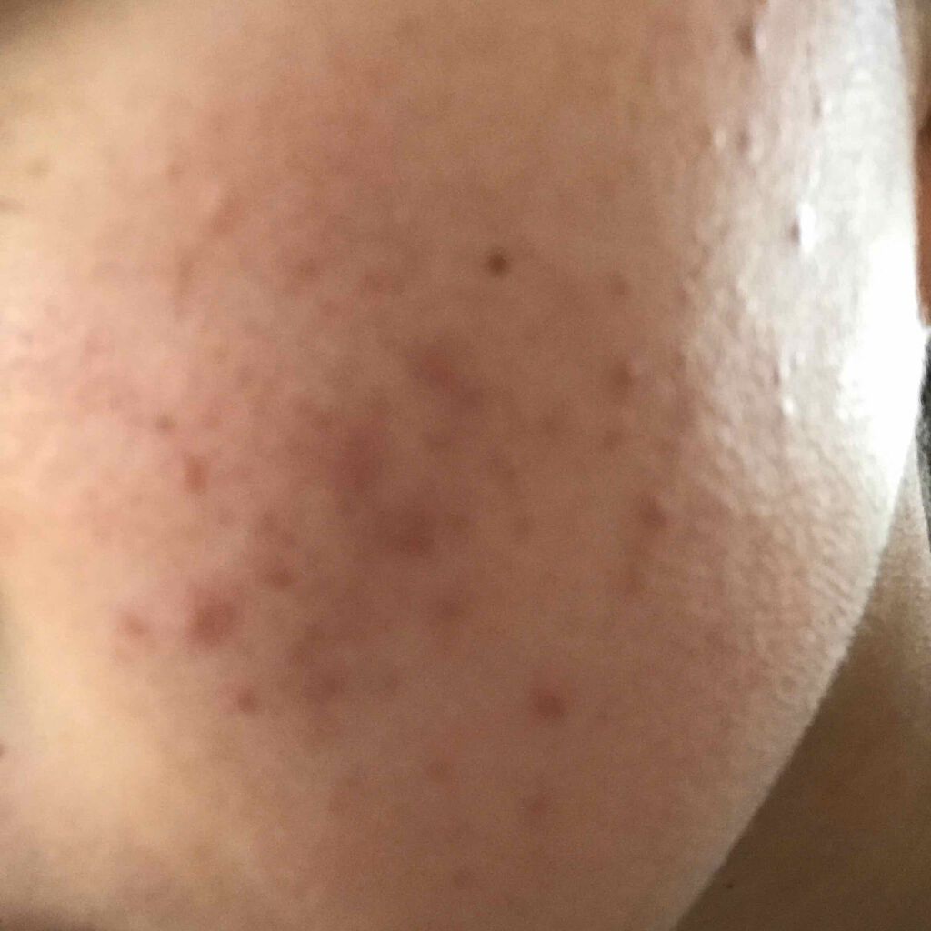 pito on LIPS 「ニキビ、ニキビ跡に悩んでます!!!1ヶ月の休校の間に治したいん..」(2枚目)