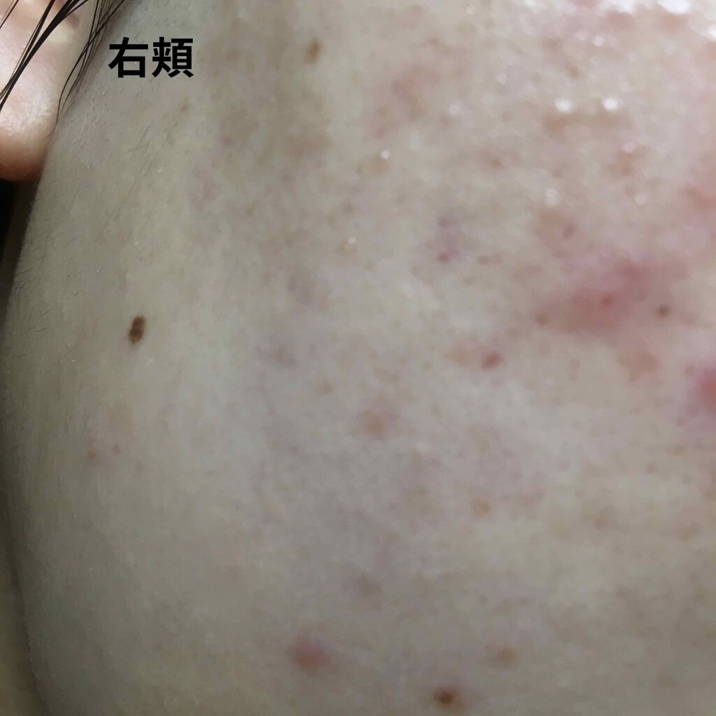 ハトムギ化粧水(ナチュリエ スキンコンディショナー R )/ナチュリエ/化粧水を使ったクチコミ（3枚目）