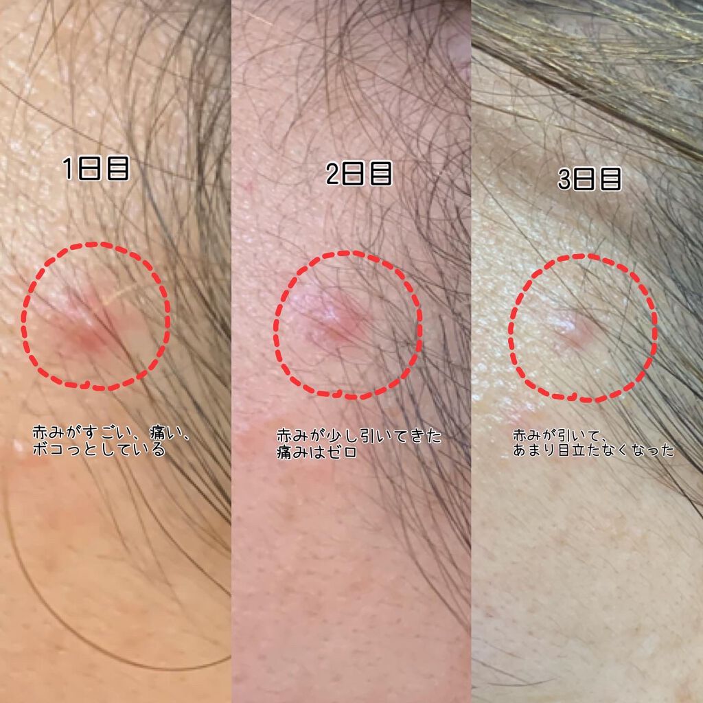 jebi on LIPS 「ニキビパッチを探せ!/#TIRTIR#acカーミングアウトスポ..」(3枚目)