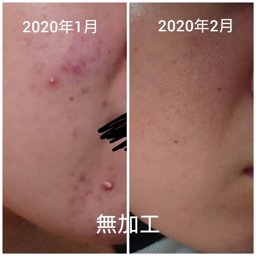 クラリファイング ローション 2/CLINIQUE/拭き取り化粧水を使ったクチコミ（2枚目）