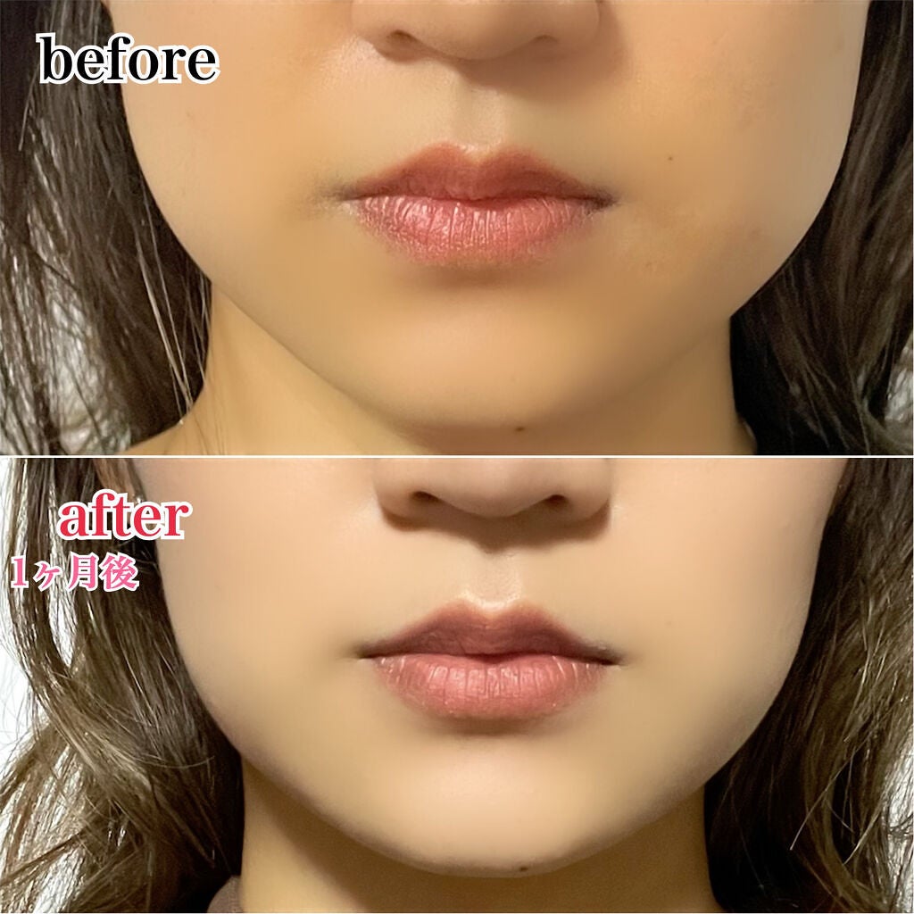 sayu on LIPS 「ずっとずっとやりたかったエラボトックス受けて来ました💓今回私は..」(2枚目)