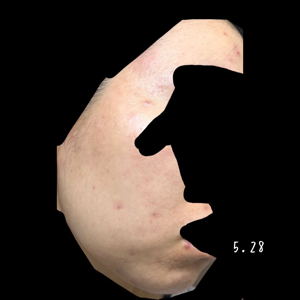 ベジータ on LIPS 「下書き消化! 5.21〜5.30オルビスのニキビケアシリーズ気..」(7枚目)