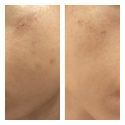 あにゃにゃ♡フォロバ100♡ on LIPS 「7回目のフォトシルクプラス後1週間の変化🙌※去年の8月から品川..」(6枚目)