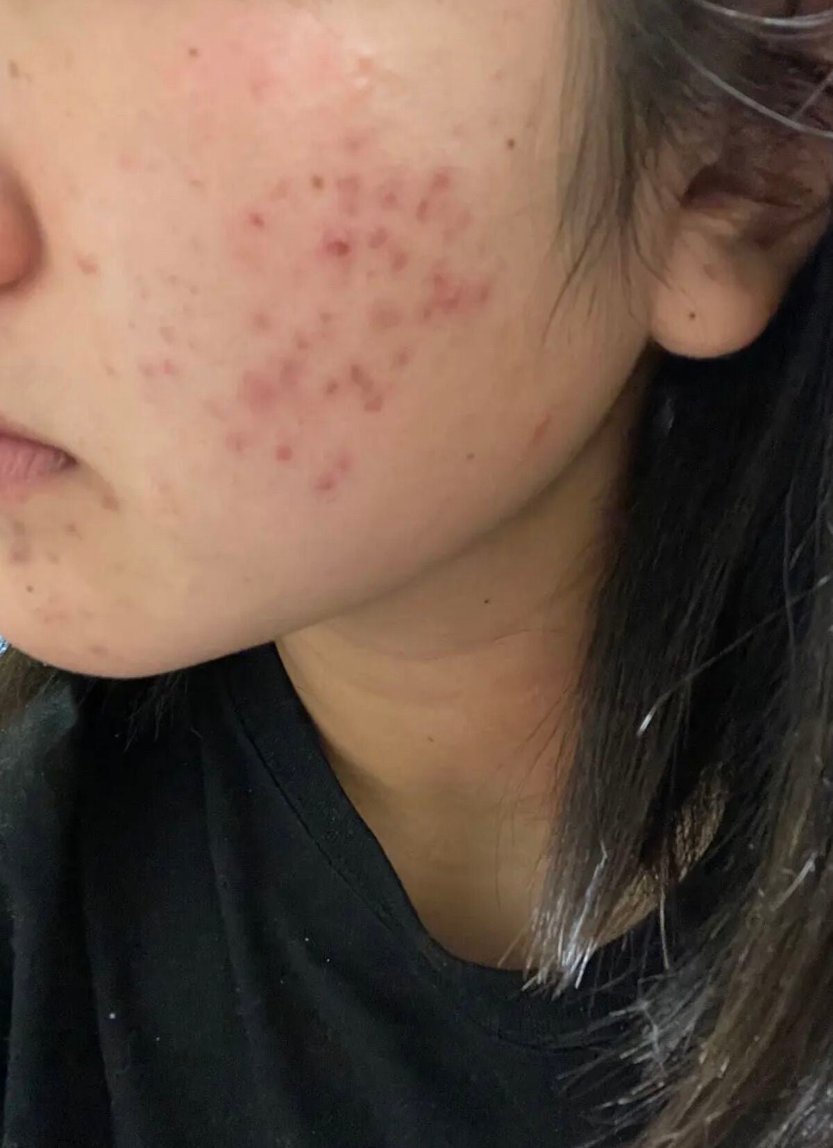 りーちゃん on LIPS 「ニキビどうしたら治りますか。今はニキビ専用エステに通ってて化粧..」(6枚目)