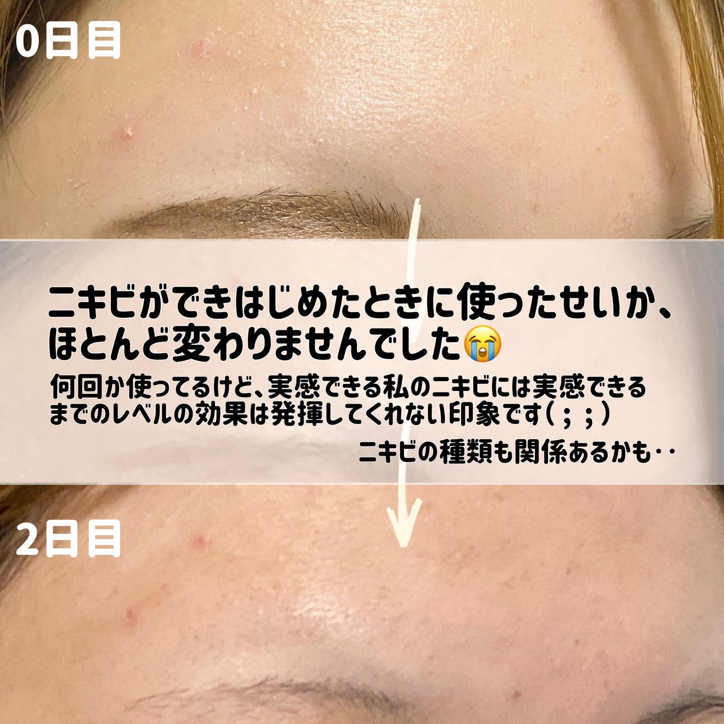 AZアゼライン酸10セラム/コスデバハ/美容液を使ったクチコミ(4枚目)