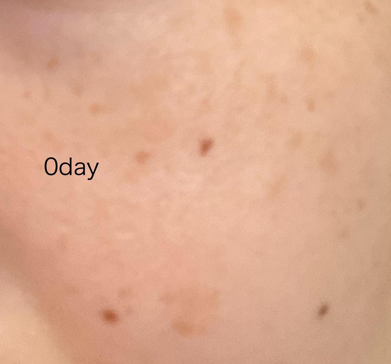 アゼライン酸15 インテンスカーミングセラム/Anua/美容液を使ったクチコミ（2枚目）