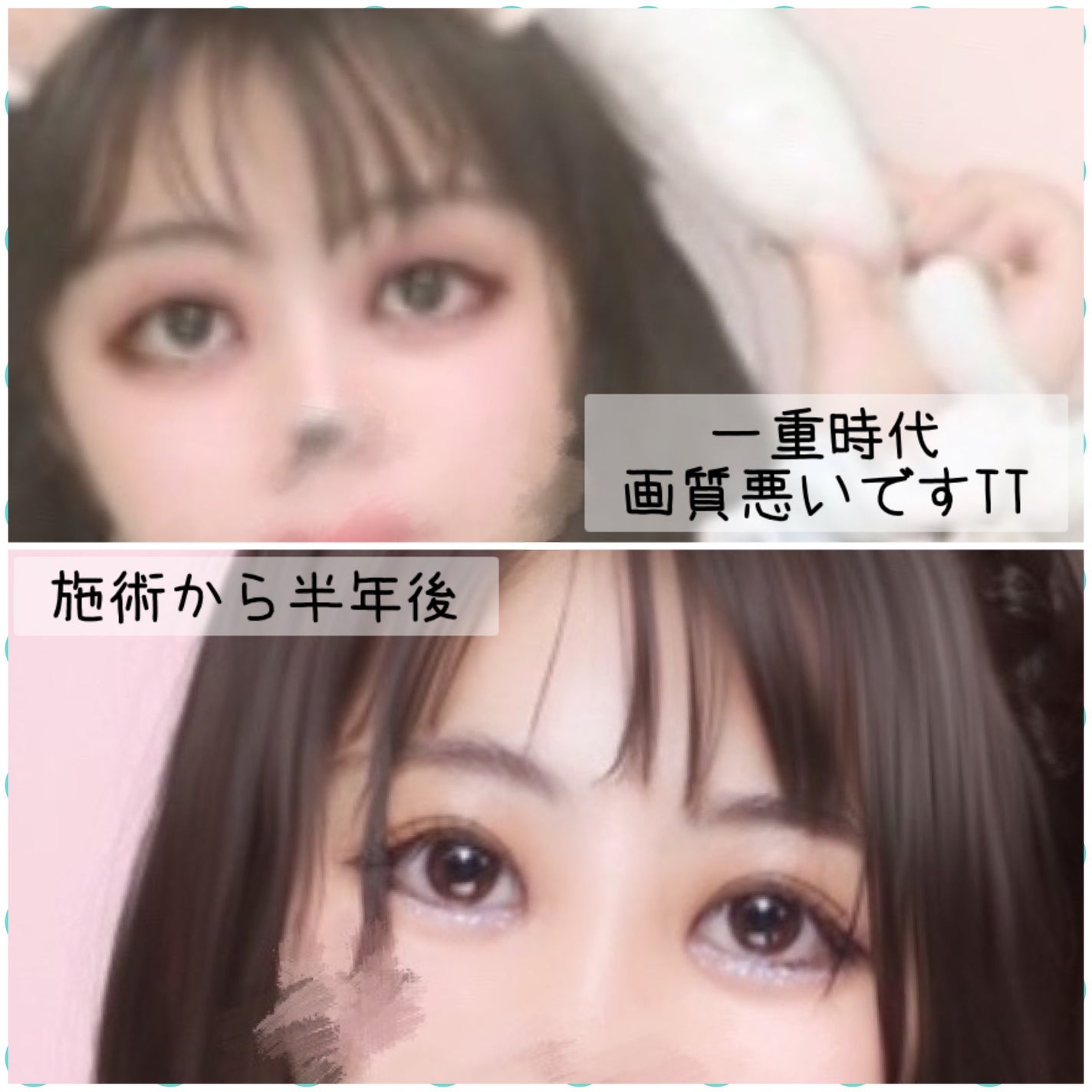 りんごあめ on LIPS 「先日、二重整形の埋没法の施術を受けてから1年が経過しました🙌✨..」(2枚目)