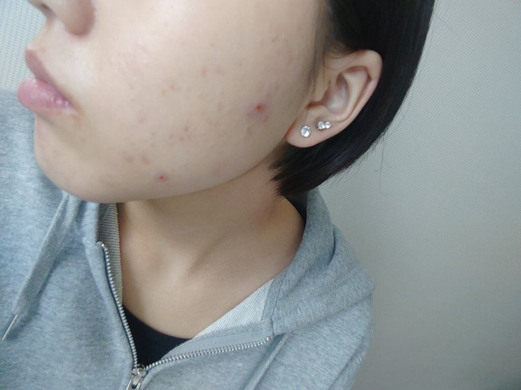 fresh_lips_cg71 on LIPS 「肌荒れ改善教えて欲しいです。🙇♀️🙇♀️🙇♀️赤ニキビは..」(1枚目)