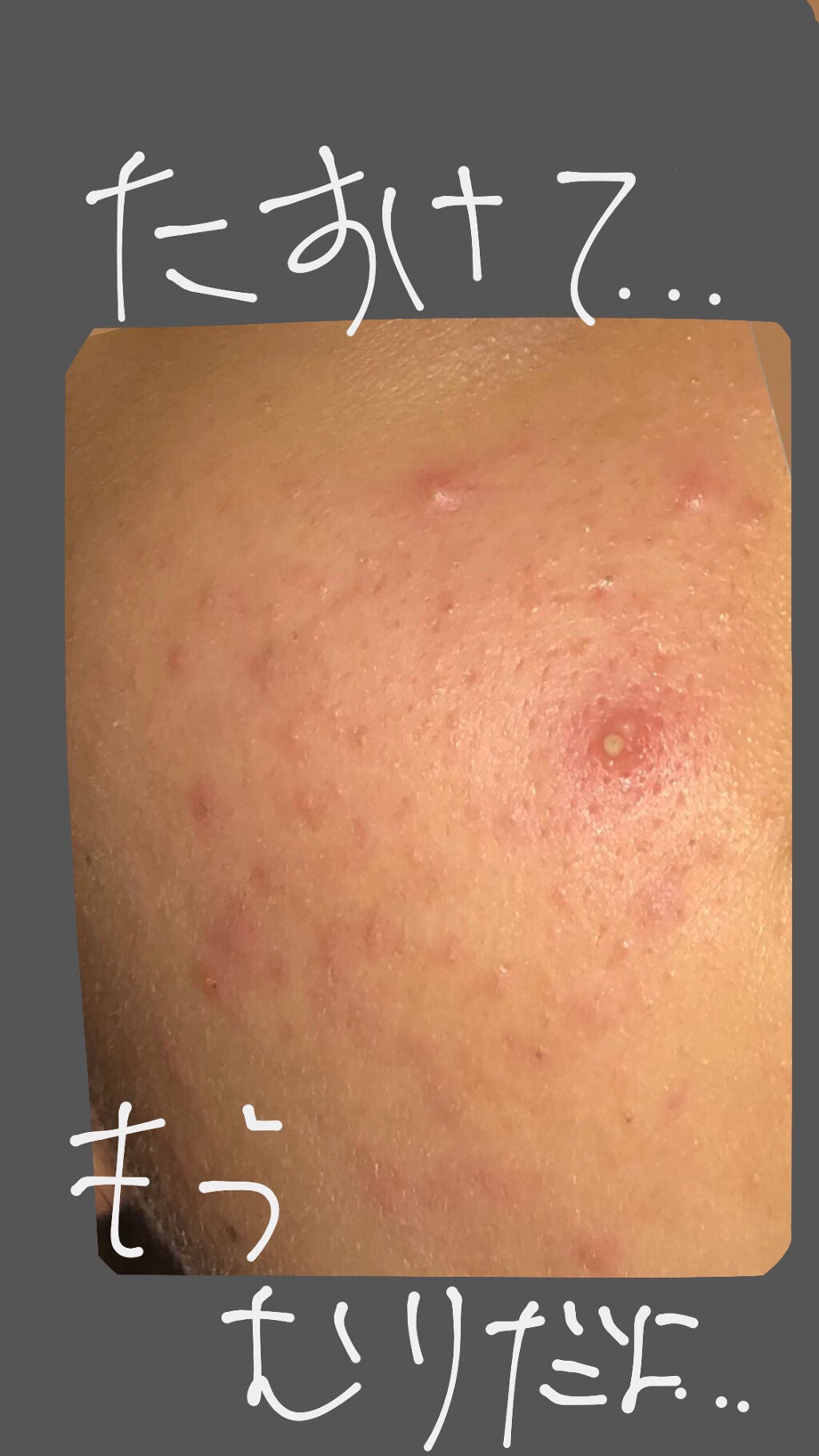 ニキビを治したい。 on LIPS 「助けてください。私のプロフィール飛んで1個目の投稿にかいてあり..」(1枚目)