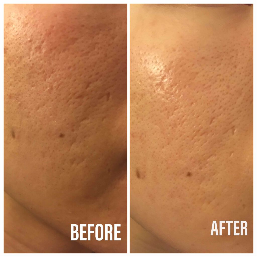 DS ライン コンセントレート 12.5 C/Kiehl's/美容液を使ったクチコミ（3枚目）