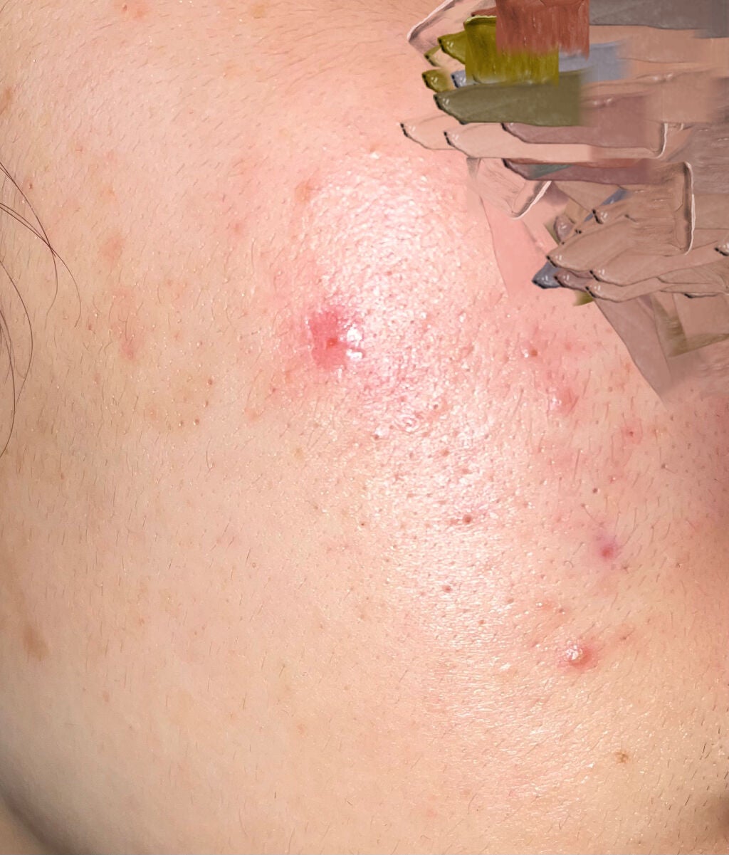 aya on LIPS 「小学六年生からニキビに悩まされてきました見た目でからかわれマス..」(3枚目)