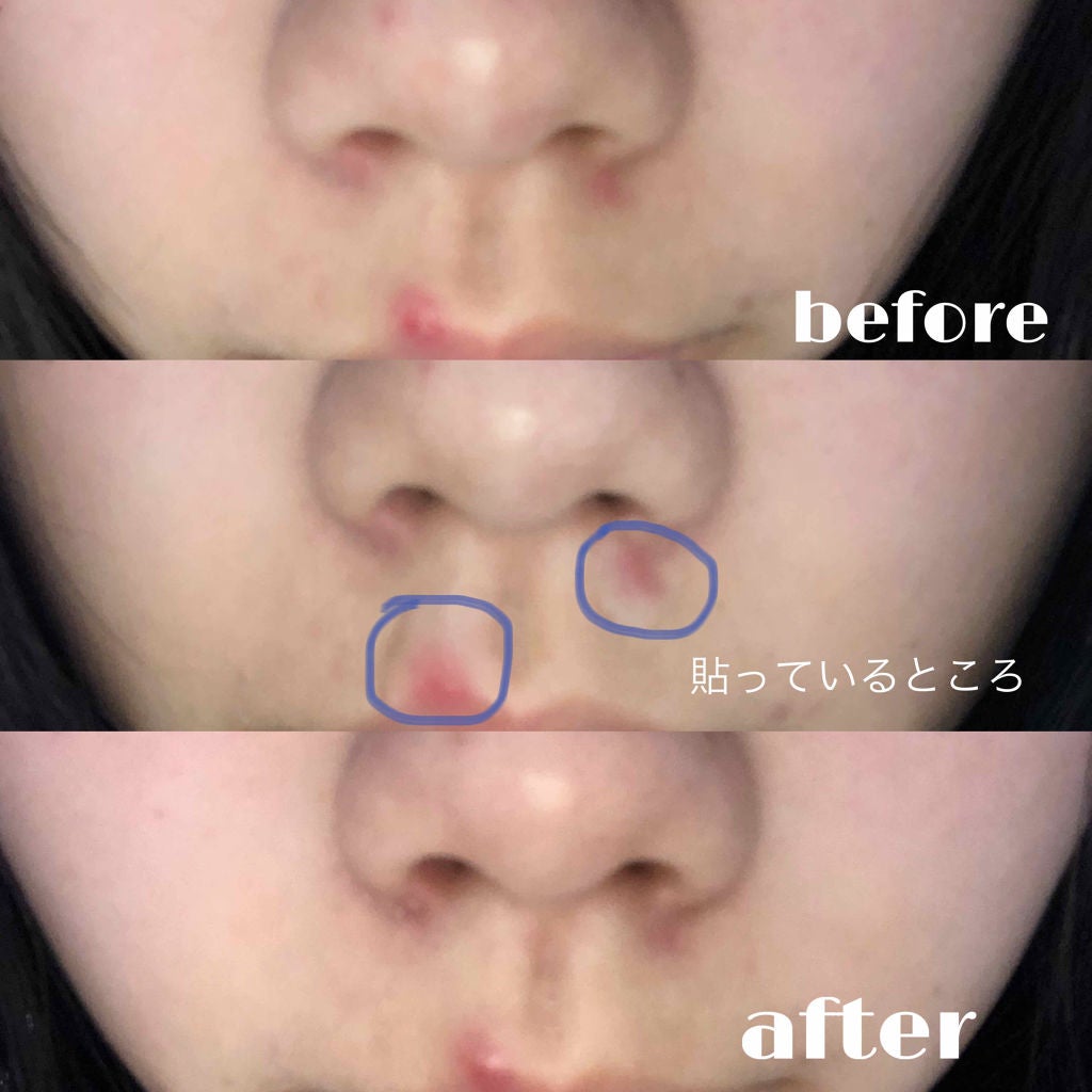 ACC パッチ/ETUDE/シートマスク・パックを使ったクチコミ(3枚目)