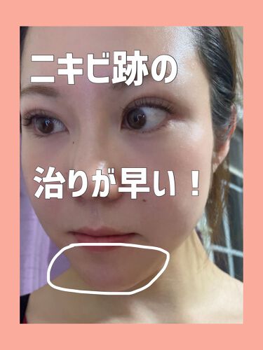 2022年最新】レチノール ニキビ跡特集!口コミで人気の47アイテムを