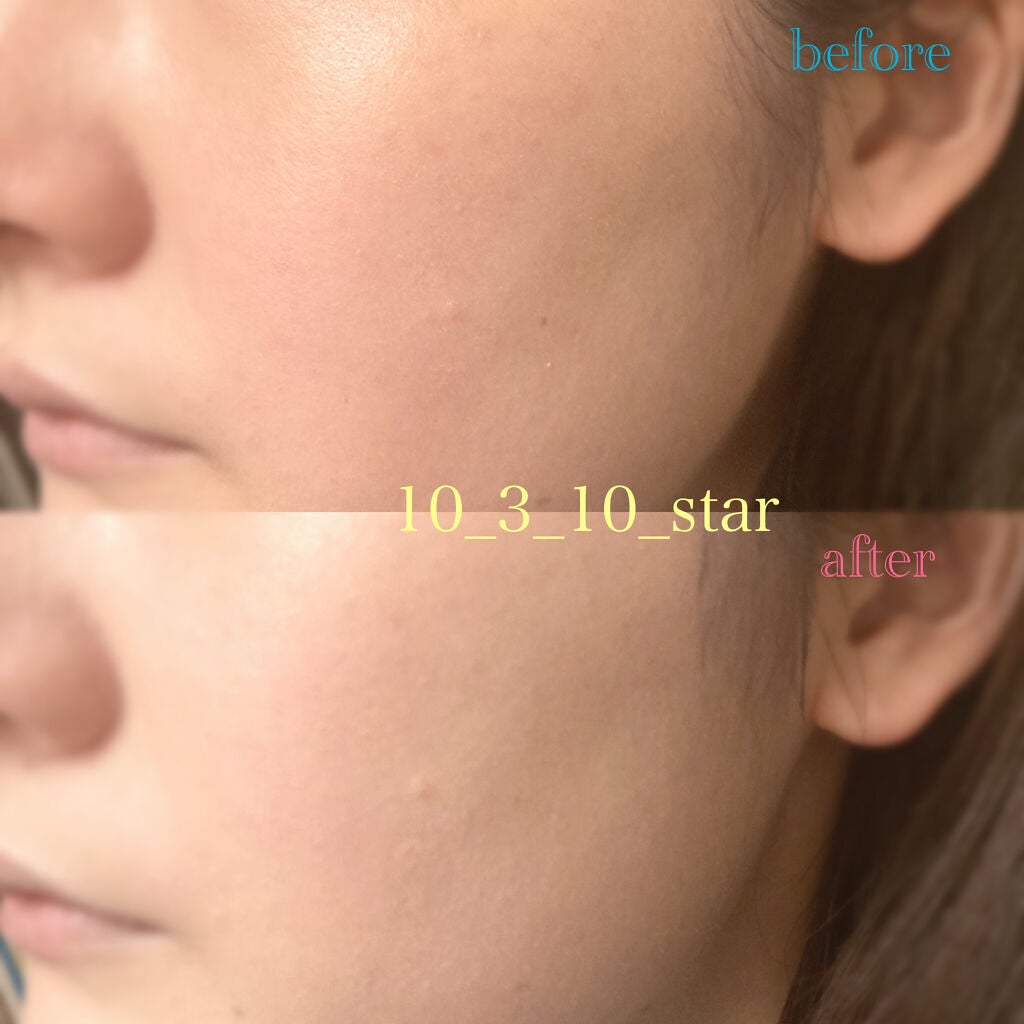 コンシール&ディファイン コンシーラー/MAKEUP REVOLUTION/リキッドコンシーラーを使ったクチコミ(2枚目)