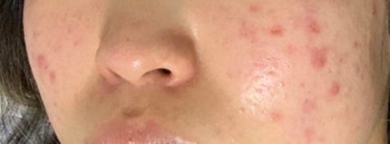 ドクダミ 77 スージングトナー/Anua/化粧水を使ったクチコミ(2枚目)