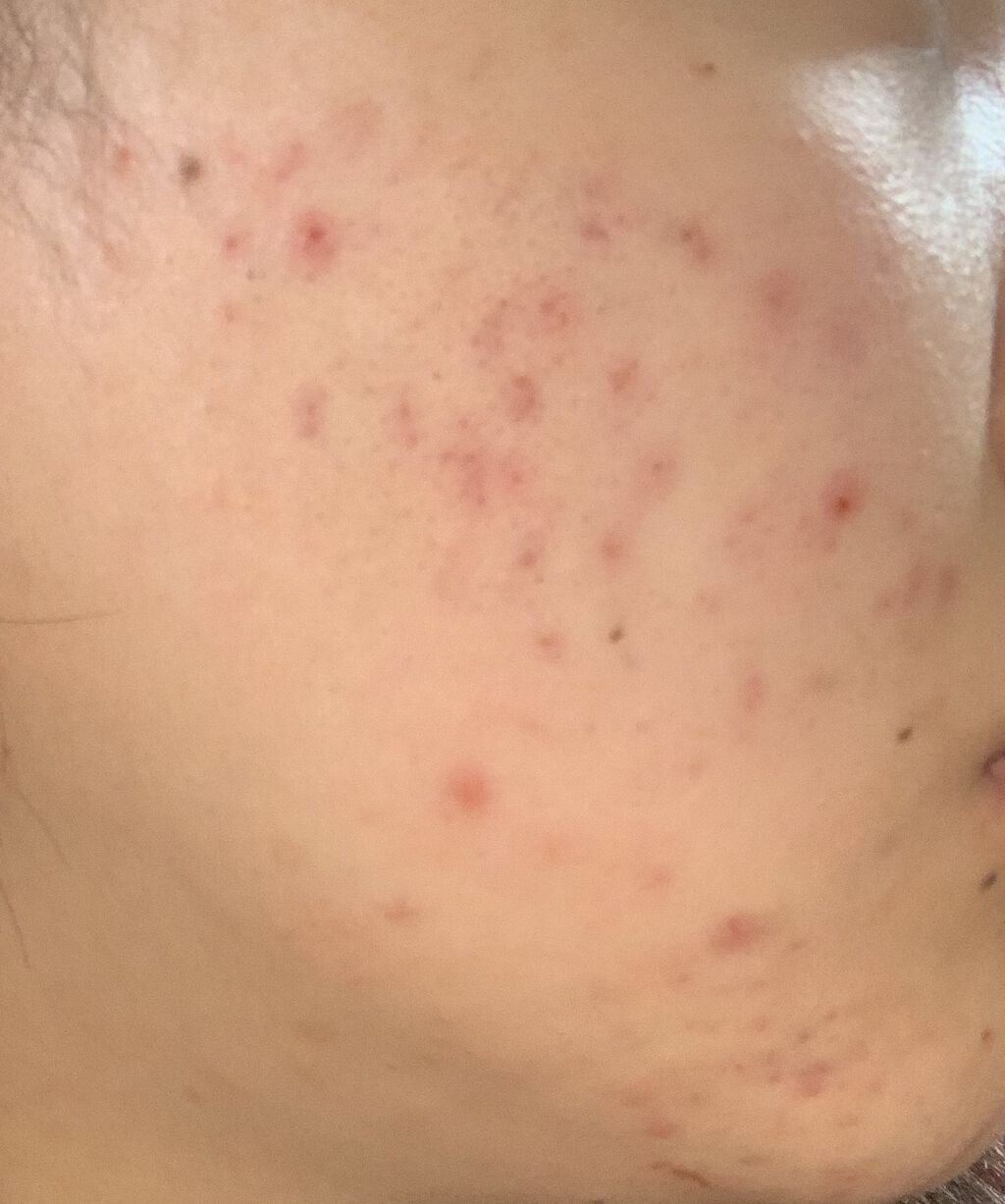 クリンダマイシンゲル(医薬品)/クラシエ薬品/その他を使ったクチコミ（2枚目）