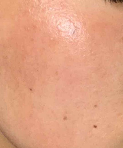 rin on LIPS 「ベピオゲル経過今、副作用に悩んでる方、ベピオゲルでの治療を検討..」(4枚目)