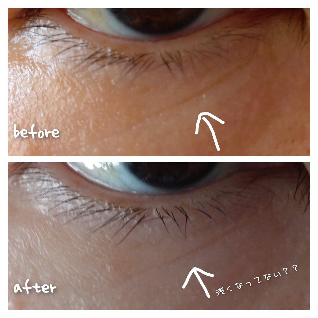 日本未発売 バイタルパーフェクション リンクルリフト ディープレチノ