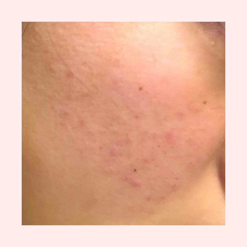 はーぺこ on LIPS 「初めての投稿です。私は中学生の頃からずっとニキビで悩んでいます..」(3枚目)