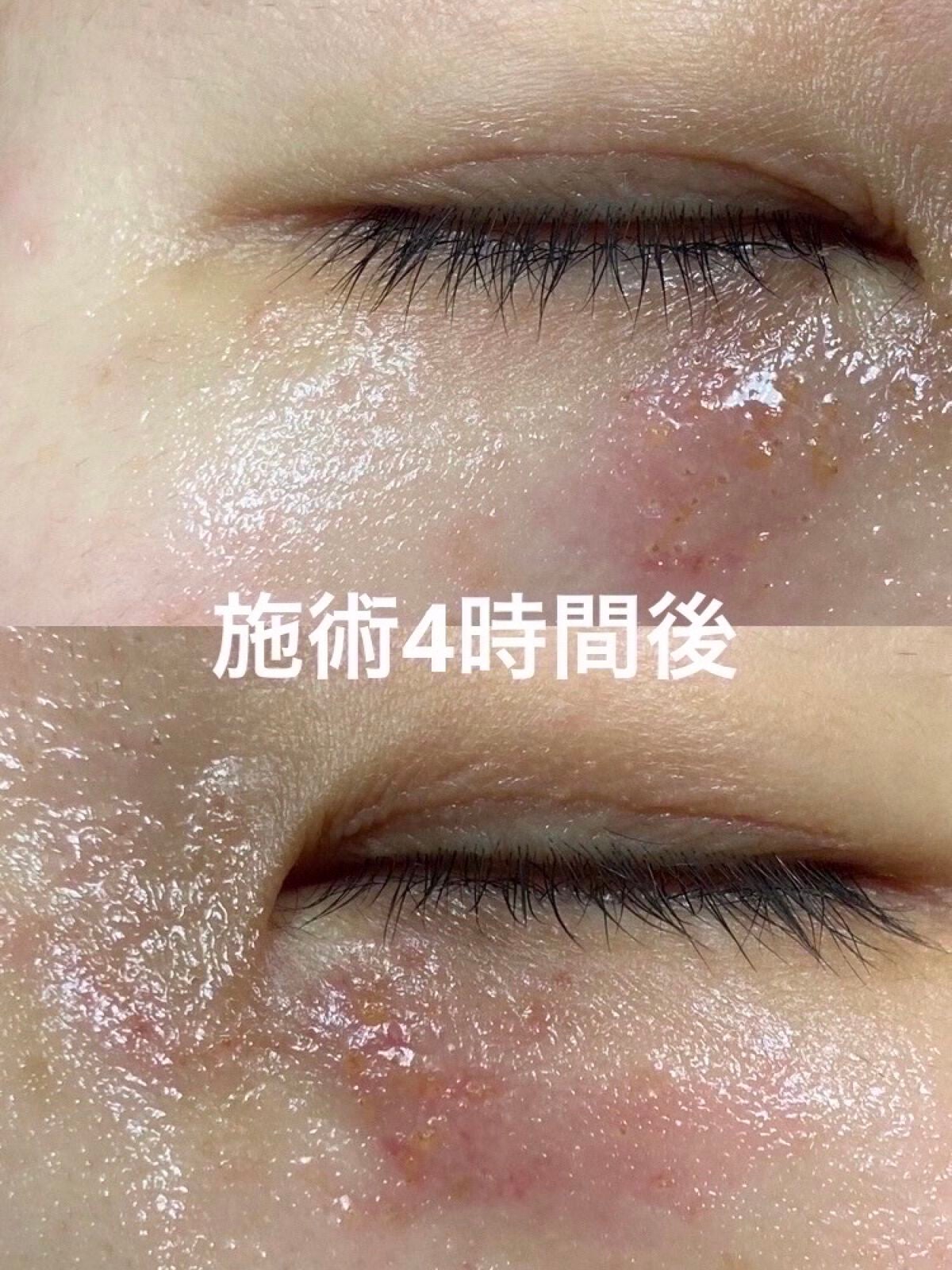 みっすん on LIPS 「目の下のポツポツをアグネスで治療してみた───────────..」(3枚目)