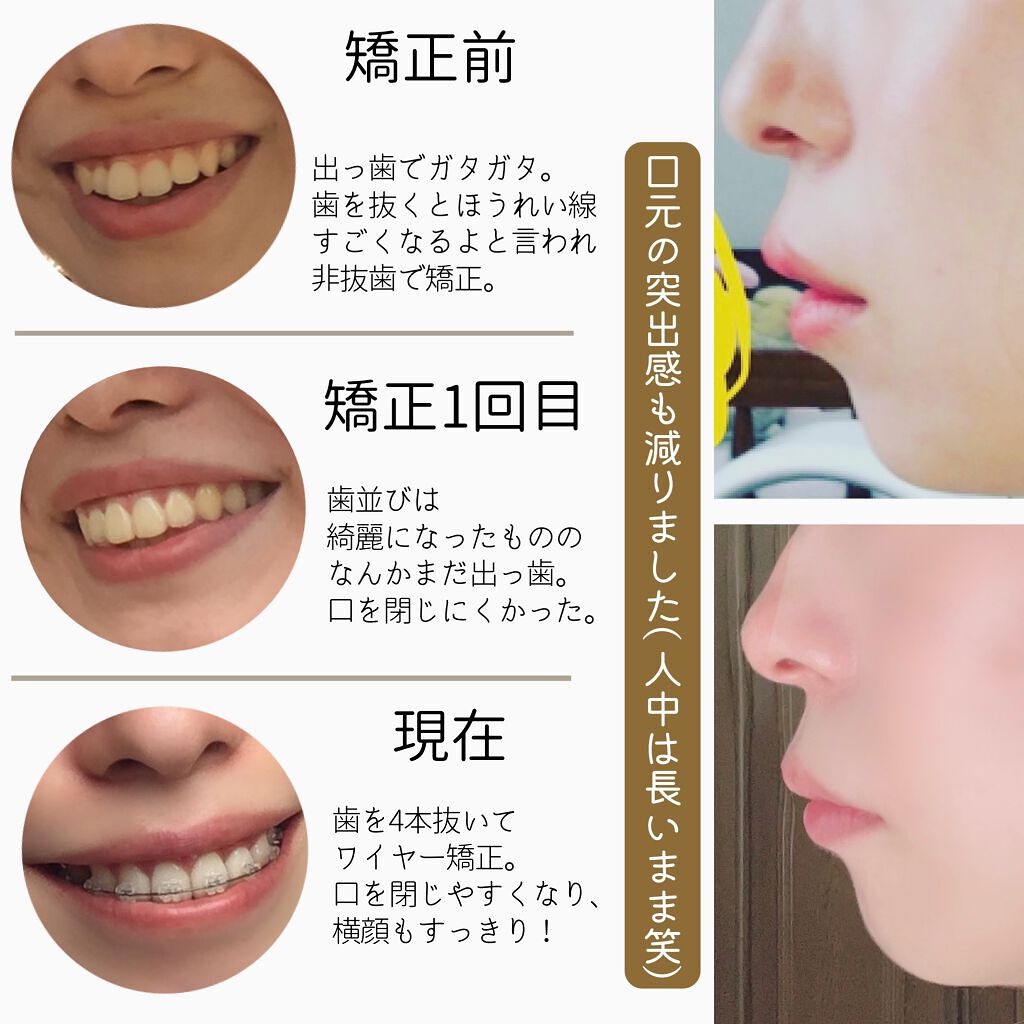 rani⌇ on LIPS 「こんばんは、らにです🍒今日はコスメでは無いですが歯列矯正につい..」(4枚目)