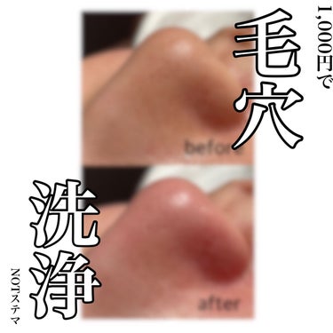 憫(びん) on LIPS 「【たった1000円！　毛穴が気になる方必見‼︎😳】　⚠️bef..」（1枚目）