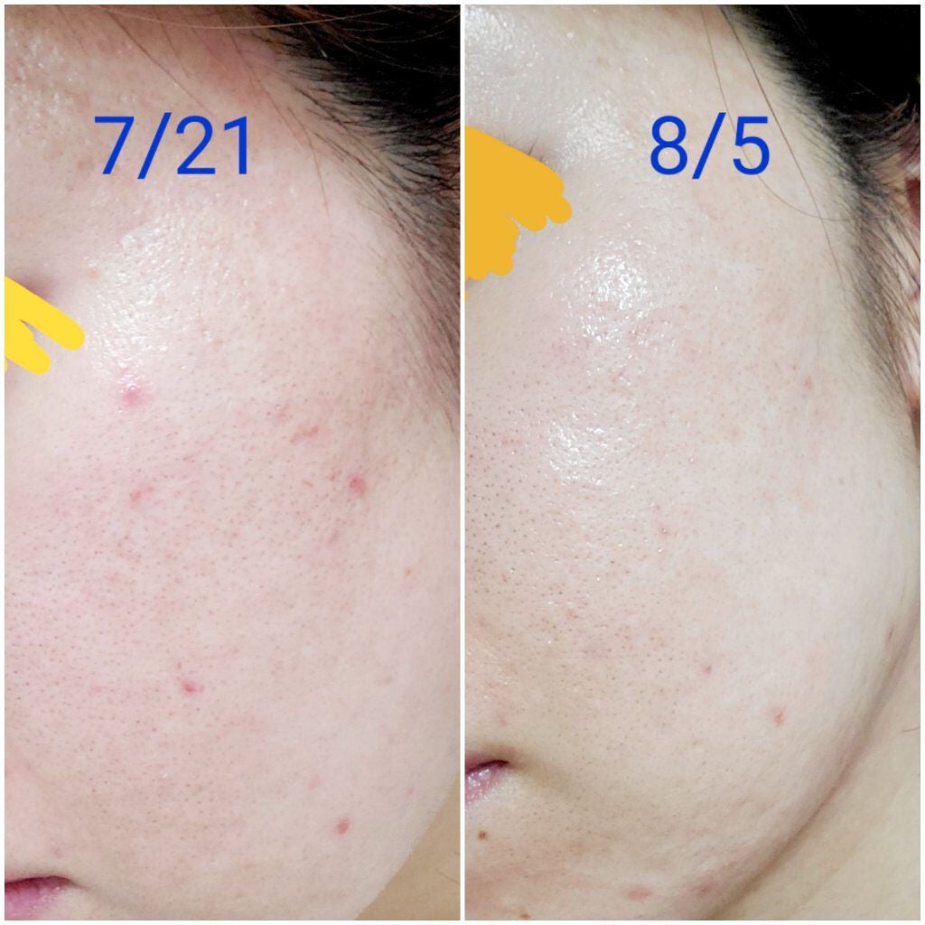 fantastic_blush_a8j on LIPS 「【使った商品】BLANC ブランクリーム【肌質】敏感肌、ニキビ..」(1枚目)