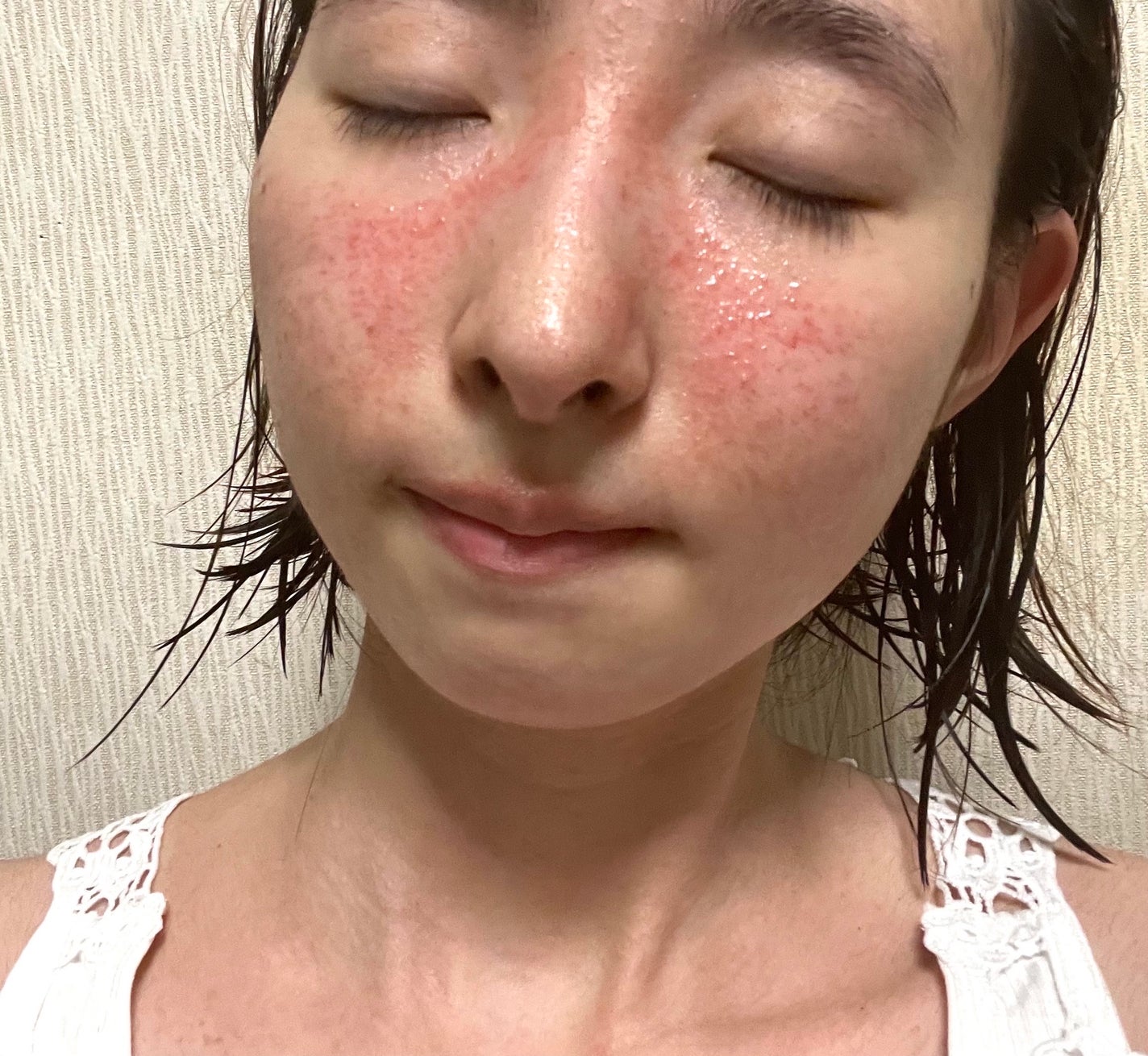 Mikaringo on LIPS 「元々肌が白かったのもあり日焼けをすると赤くなったり痒みが出たり..」(3枚目)