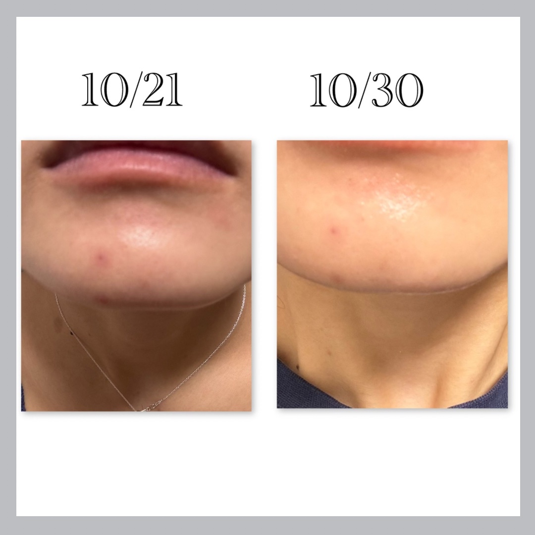 レッドブレミッシュ クリアスージングクリーム/Dr.G/フェイスクリームを使ったクチコミ（2枚目）