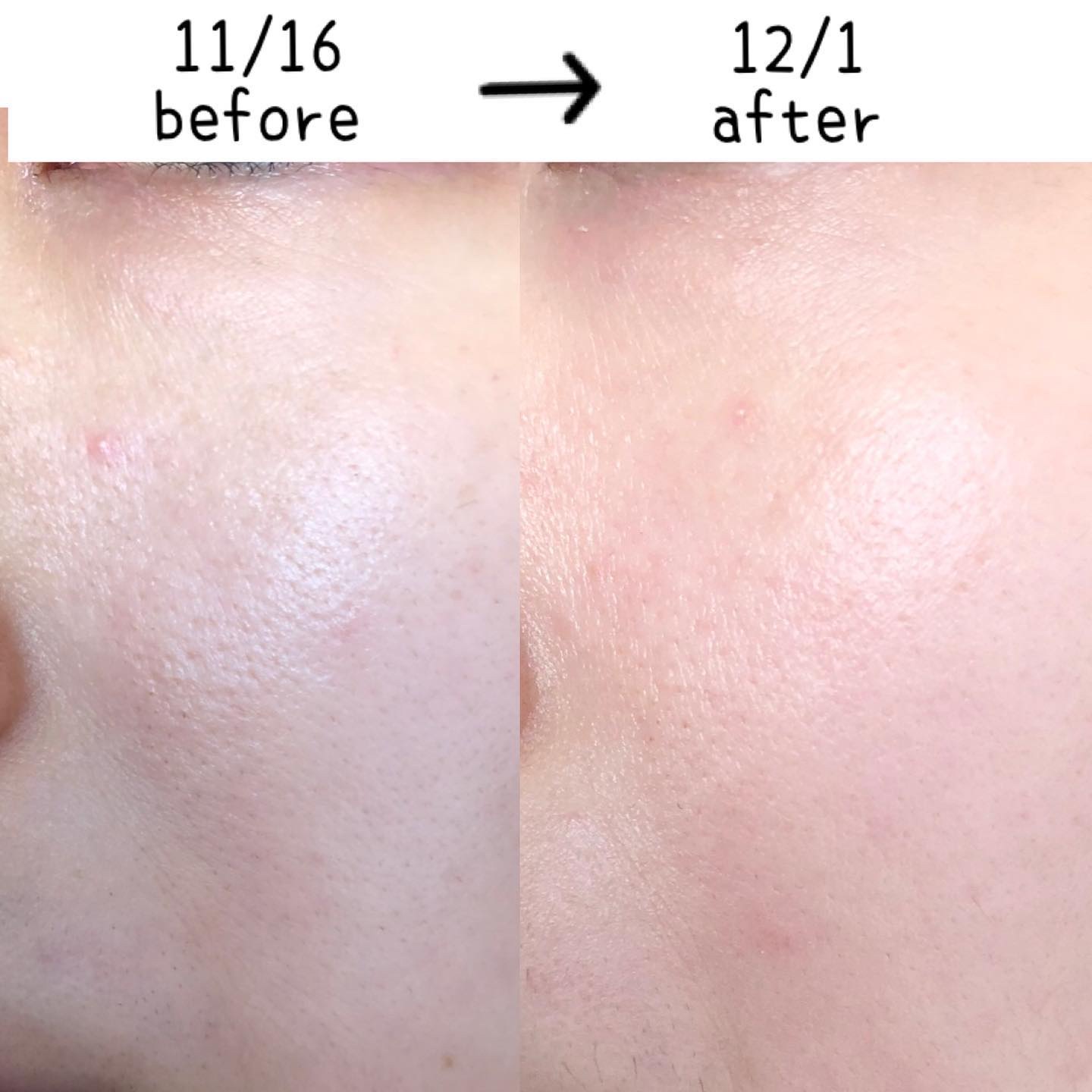 リードルショット300/VT/美容液を使ったクチコミ（2枚目）