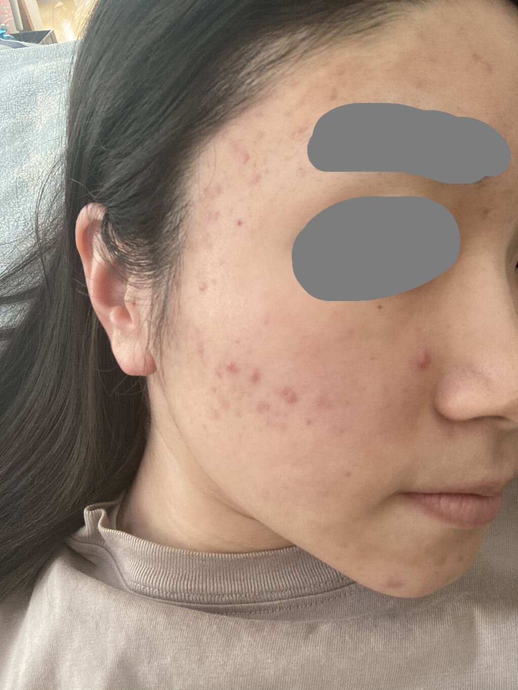 テラ・コートリル 軟膏(医薬品)/ジョンソン・エンド・ジョンソン/その他を使ったクチコミ（2枚目）