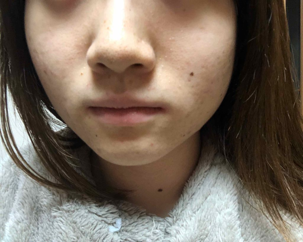 マンスリースキンケアプログラム(旧)/APEX/スキンケアキットを使ったクチコミ(2枚目)