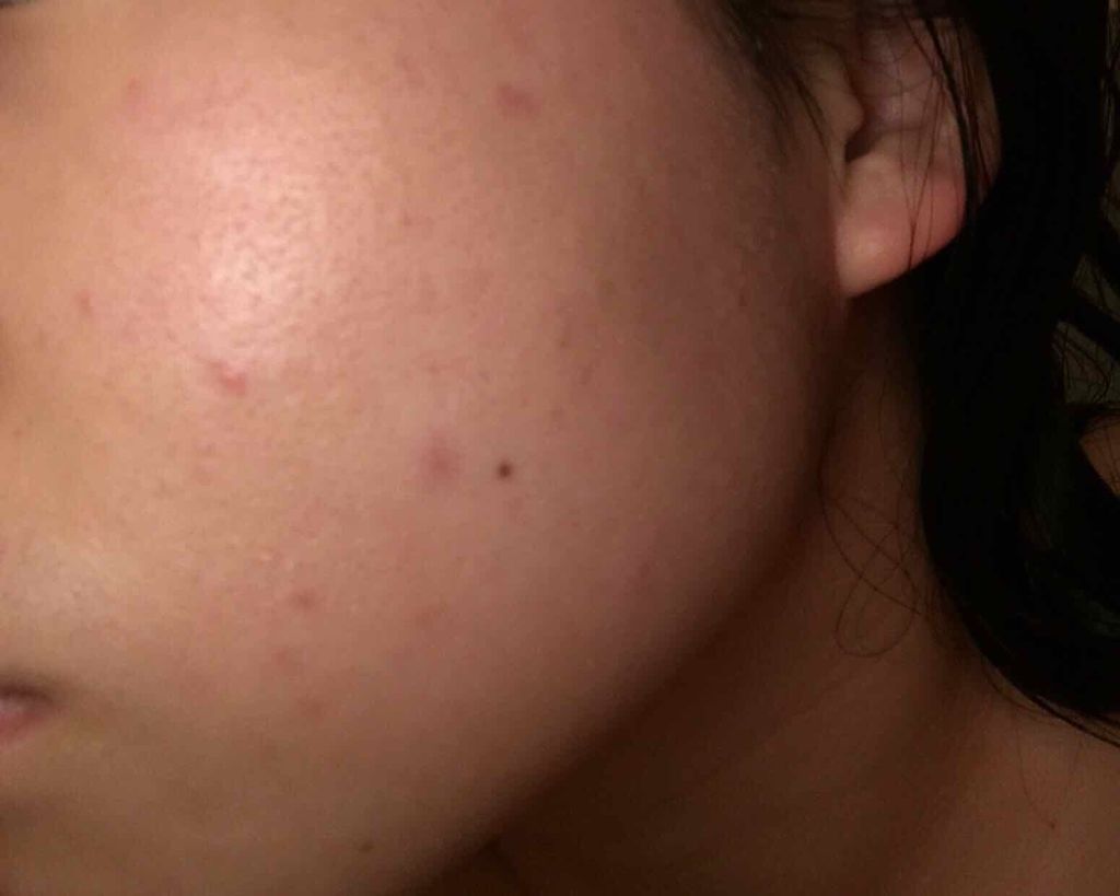 ゆめ on LIPS 「⚠️2枚目、3枚目汚肌です。2枚目がbefore3枚目がaft..」(3枚目)